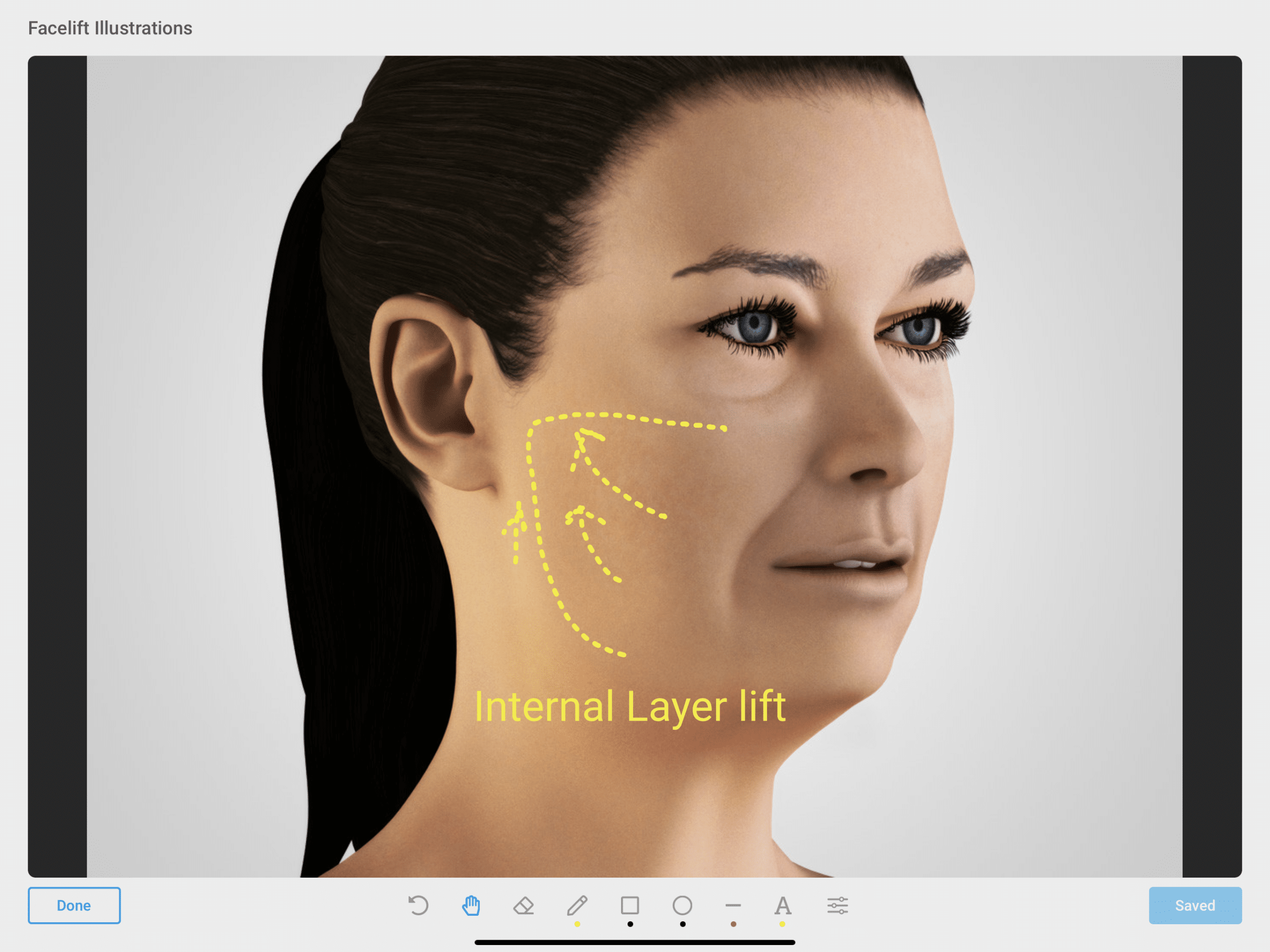 S-Lift includes an internal anchoring for prolonged stability of results.