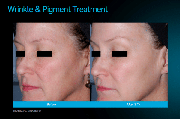 Picosure Laser Rejuvenation in Buffalo, NY Skin Rejuvenation